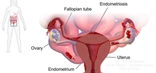 Endometriozis Özellikleri ve Faydaları Nelerdir?